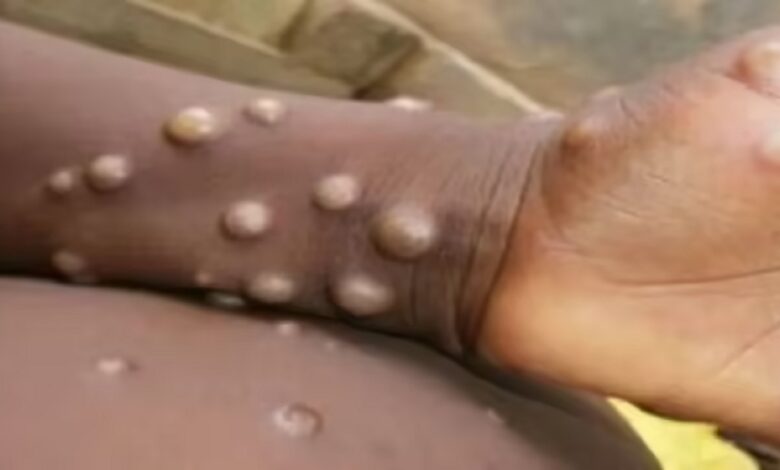 monkeypox, WHO, Africa